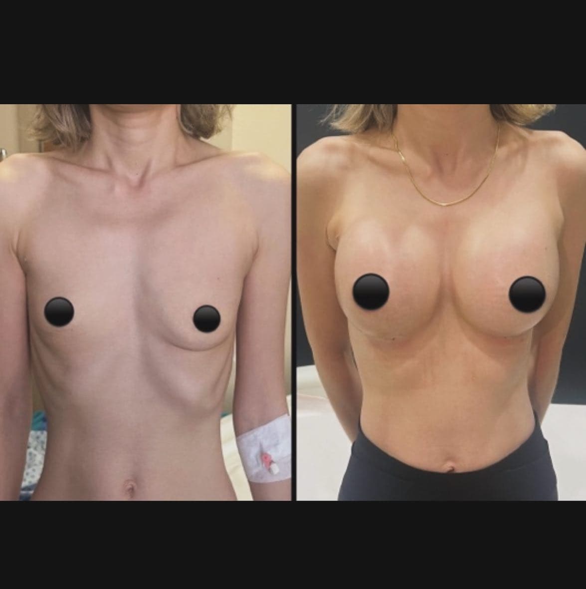 Breast implant