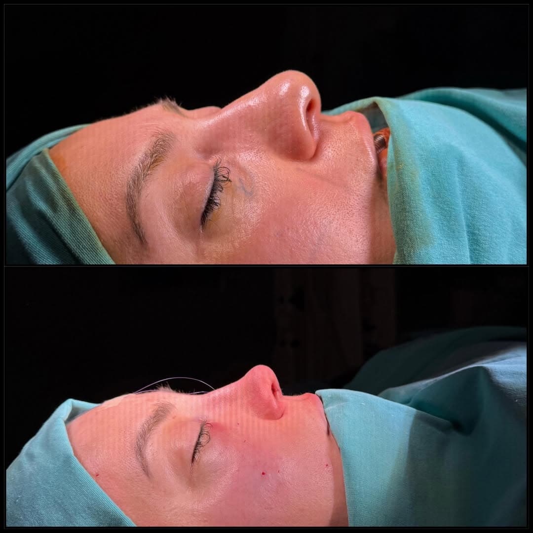 Rhinoplasty