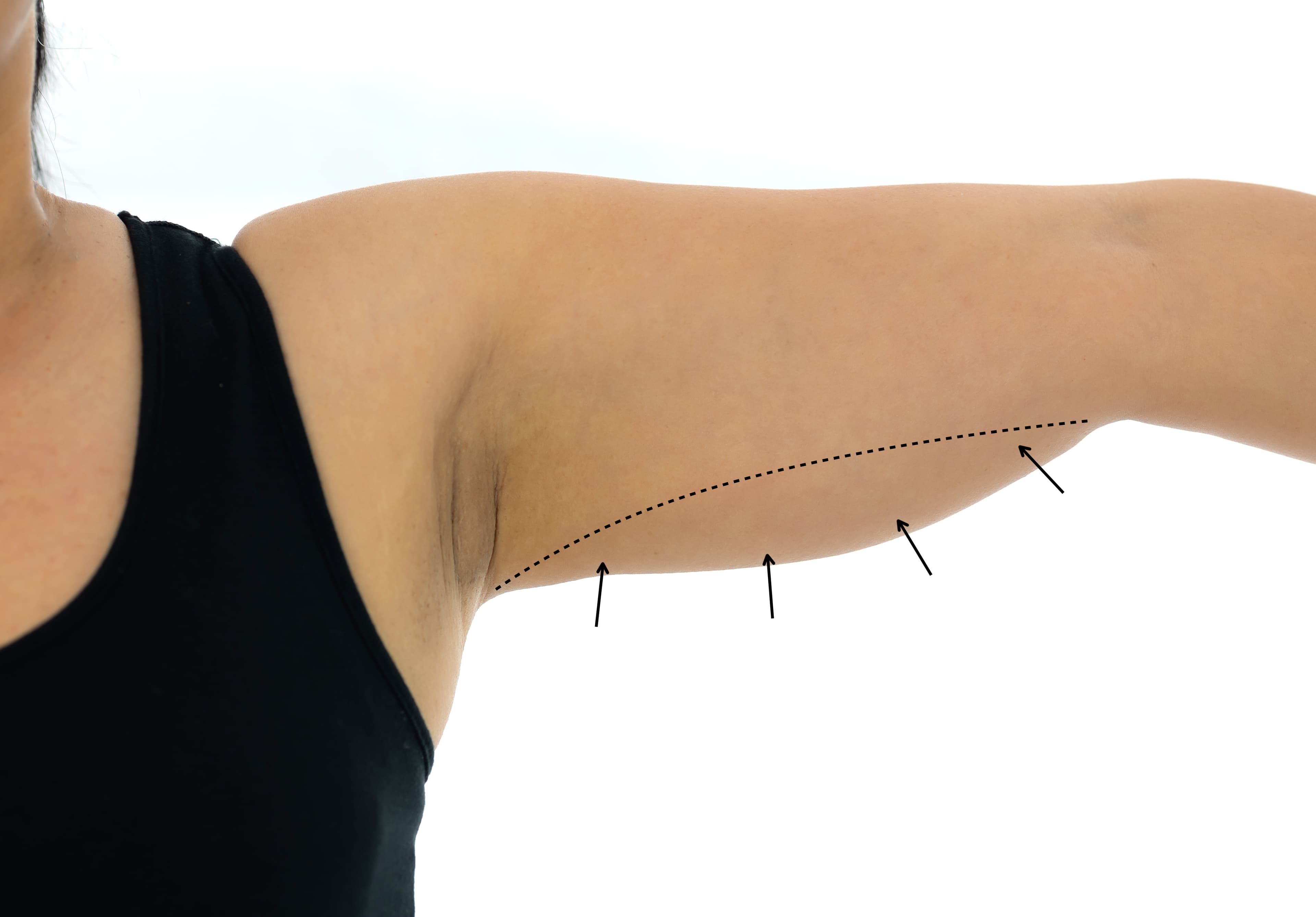 Arm Lift