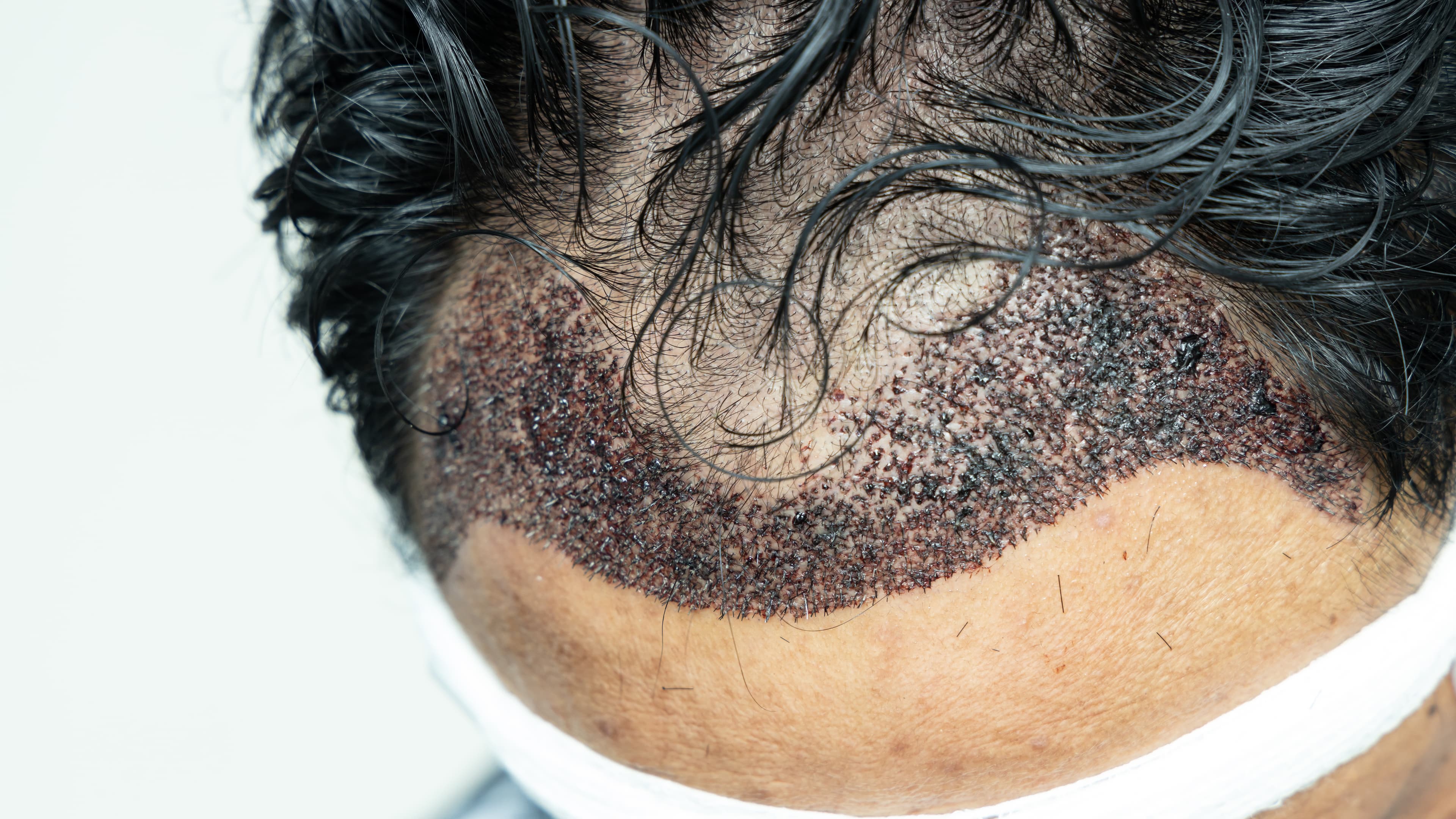 Hairline Transplant (Frontal Hairline Restoration)