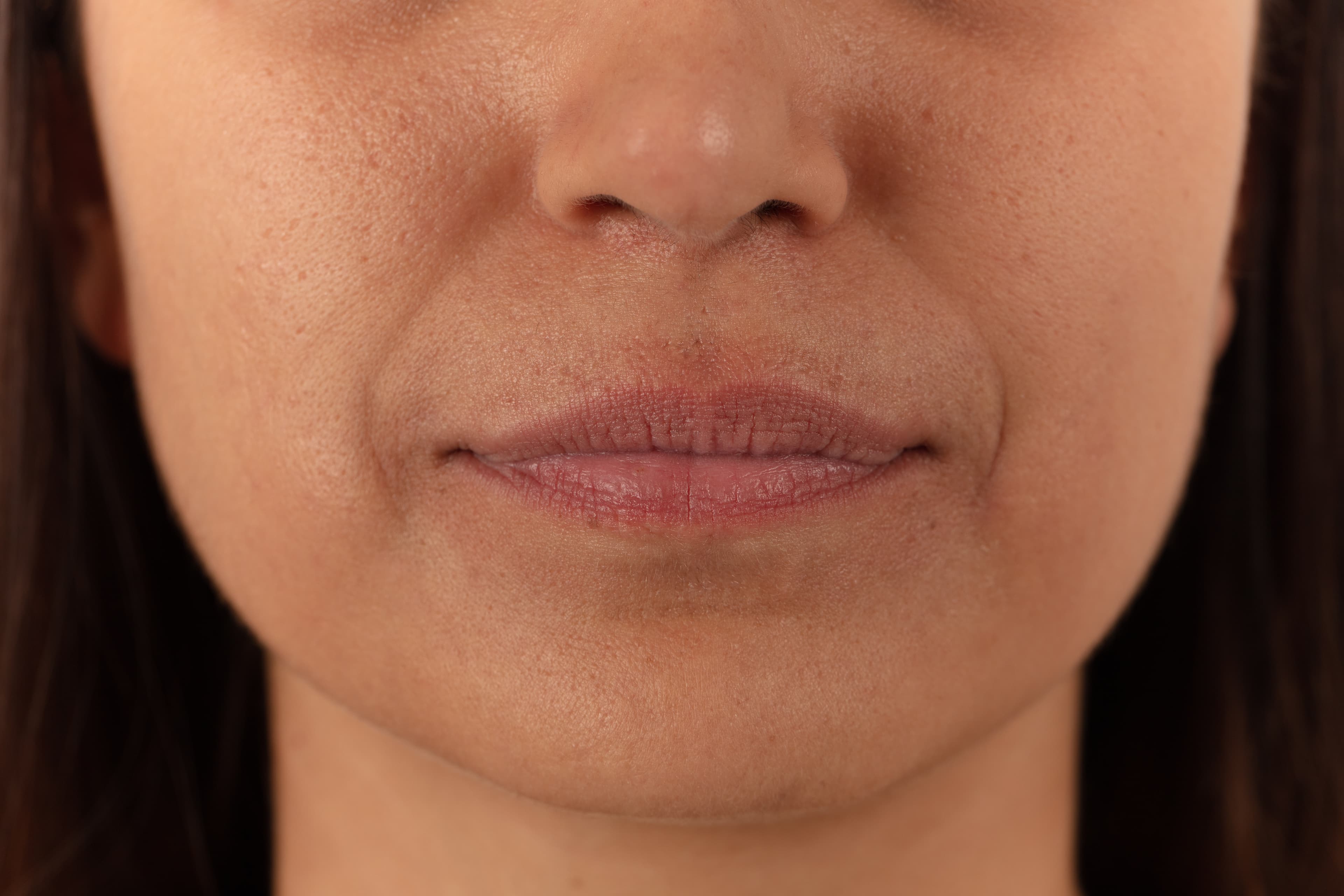 Lip Lift